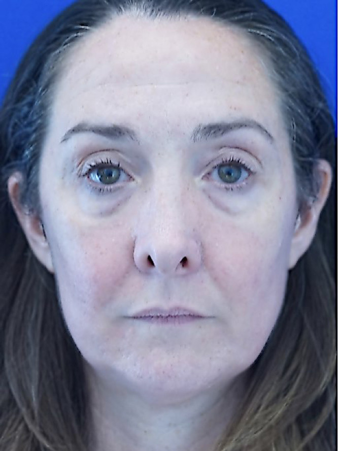 Quad Eyelid Blepharoplasty with Fat Reposition — Before