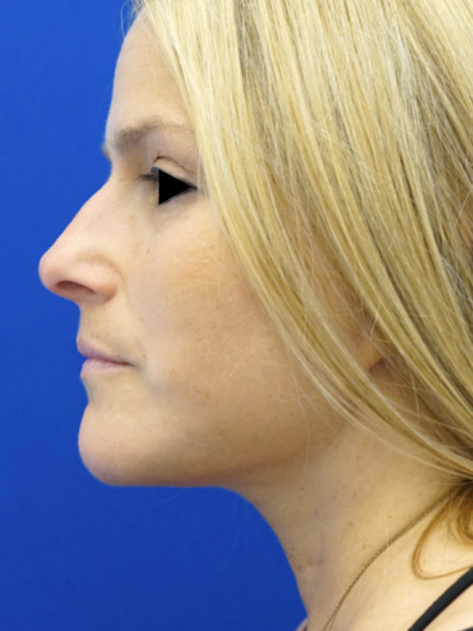 Deep Plane Lower Facelift and Platysmaplasty — After