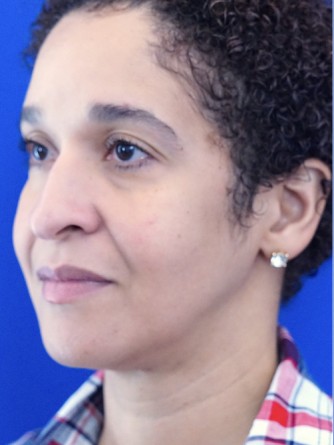 Ethnic Rhinoplasty* — Before
