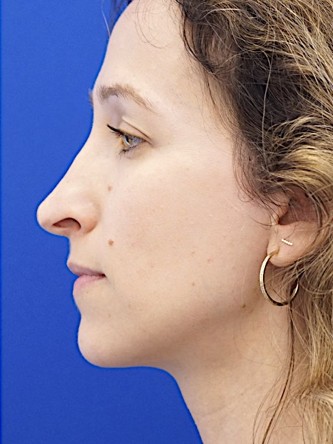 Long Nose Hanging Columella — Before
