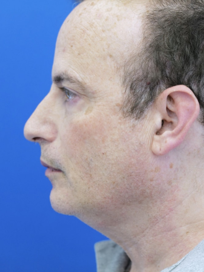 Chin Implant Reposition — After