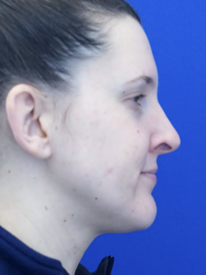 Alar Retraction and Columellar Show — Before