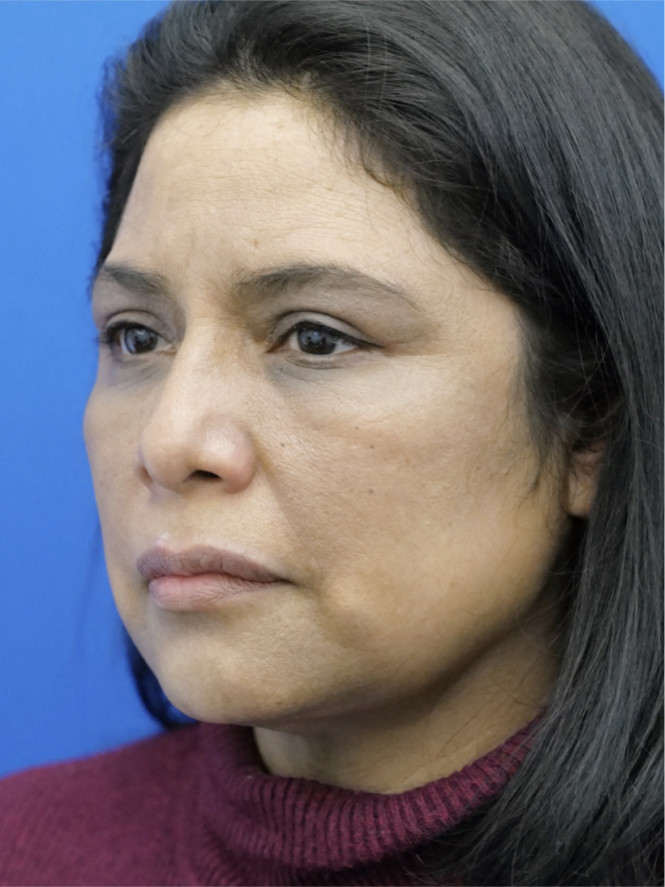 Four-Lid Blepharoplasty — After