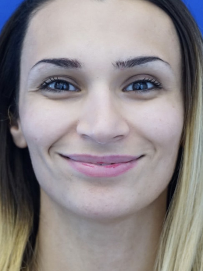 Nasal Deviation and Dainty Tip — Before