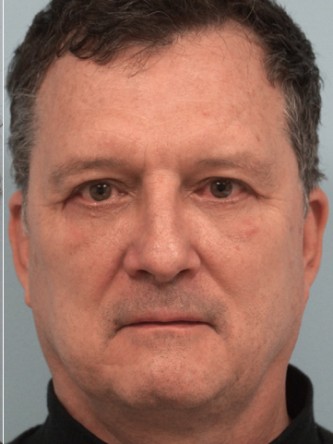Lower Eyelid Excess Fat Pad2* — After
