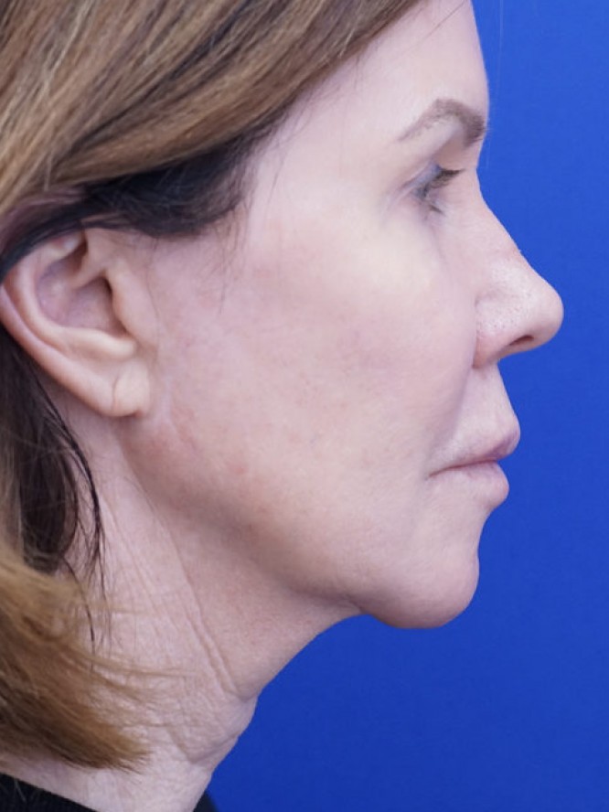 Secondary Lift and Facial Fat Grafting — Before