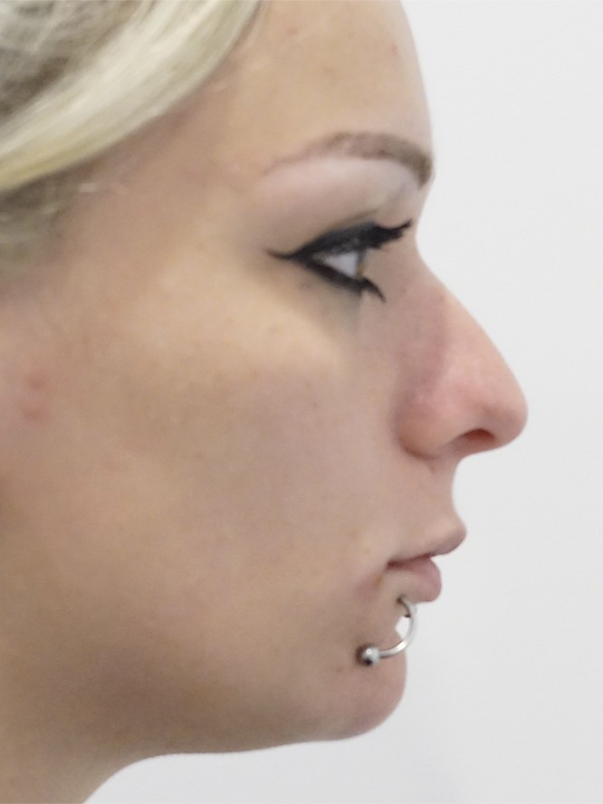 Deep Radix and Dorsal Convexity — Before