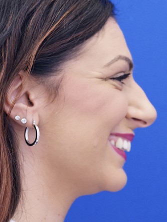 Hump Reduction* — Before