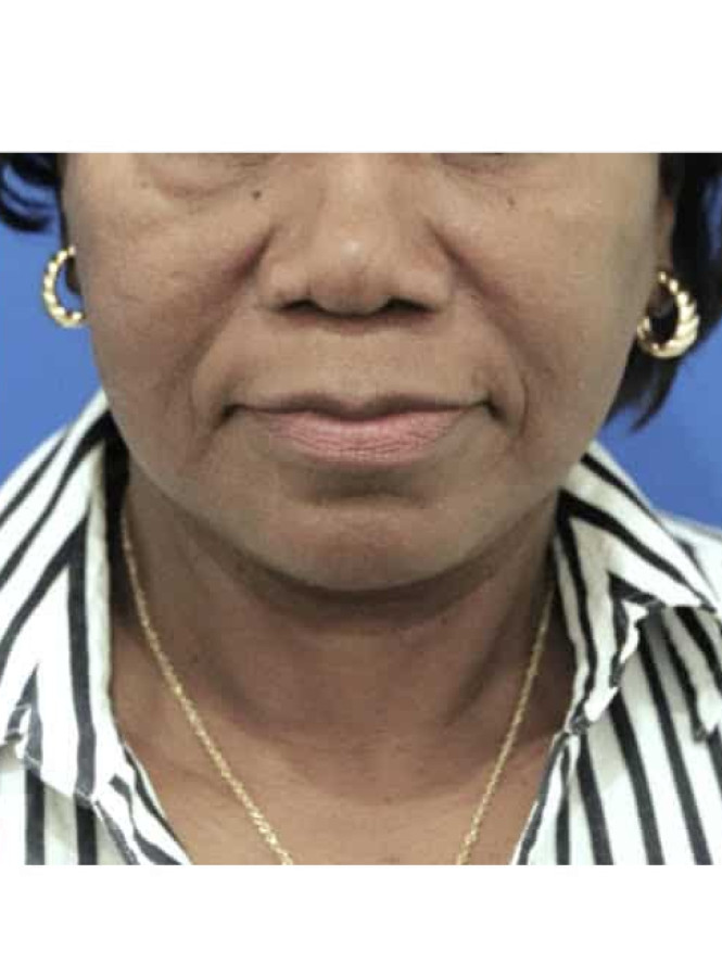 Necklift with Platysmaplasty — After