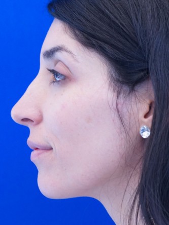 Nasal Bridge Bump* — Before
