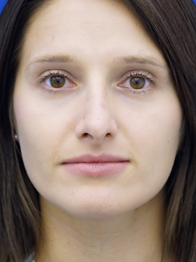 Nasal Profile Bliss — Before