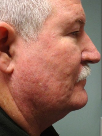 Aging Eyelid Rejuvenation, Facelift, Necklift 1* — Before