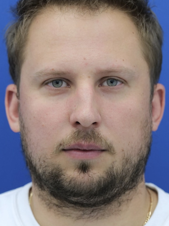 Dorsal Hump and Chin Augmentation — Before