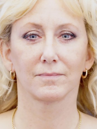 Facelift, Eyelid Skin Trim, Facial Fat Transfer* — After