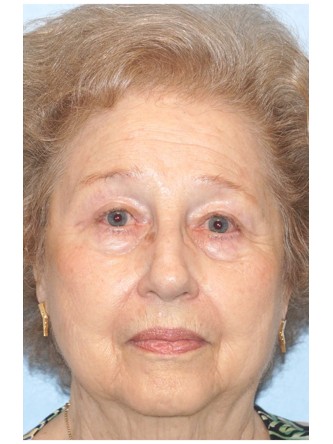 Visual Field Deficit – Eyelid Ptosis1* — After