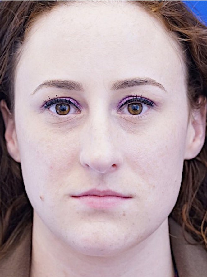 Finesse Nasal Contour — Before
