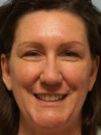 Botox Browlift2* — After
