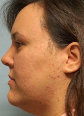 Crooked Nose Endonasal Technique2* — Before