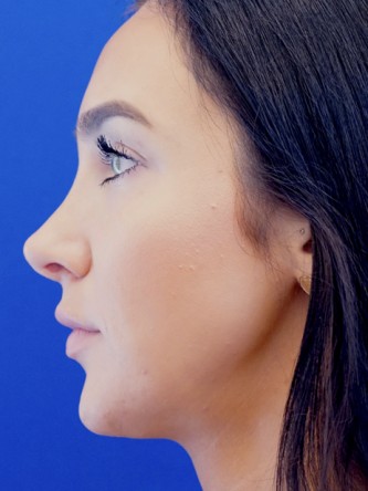 Nasal Hump Closed Rhinoplasty — After
