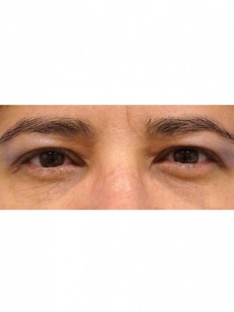 Fat Grafting to Lower Eyelid* — Before