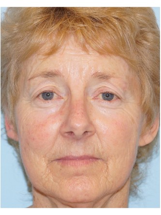 Upper Eyelid Droop2* — Before