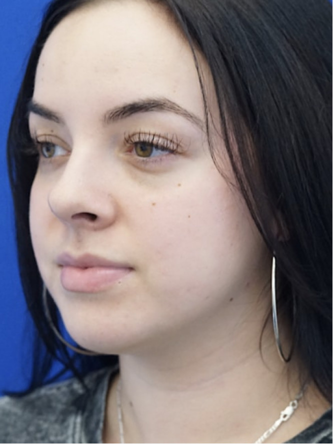 Scarless Hump Reduction — After