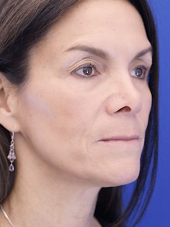Nasal Tip Deformity — Before
