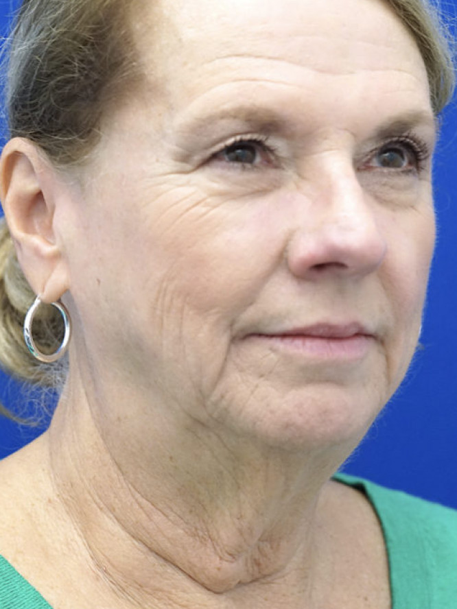 Lower Facial Aging and Fullness — Before
