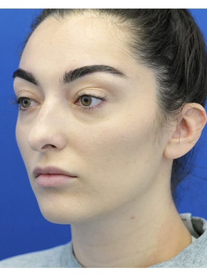 Ideal Nasal Profile — Before