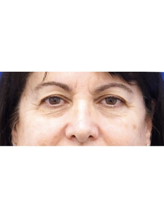 Upper and Lower Eyelid Loose Skin* — Before