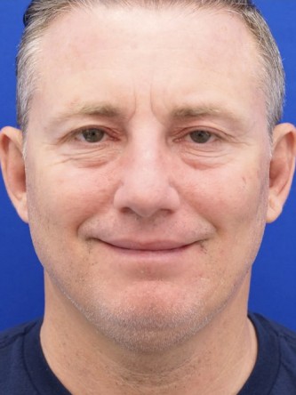 Lower Eyelid Fat Reposition — Before