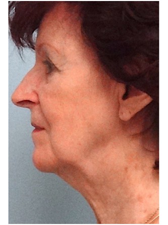 Facelift, Necklift, Platysmaplasty, ERB:YAG Laser Resurfacing* — Before
