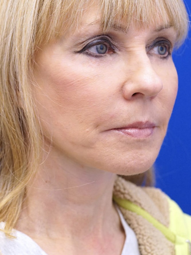 Neck Rejuvenation — After