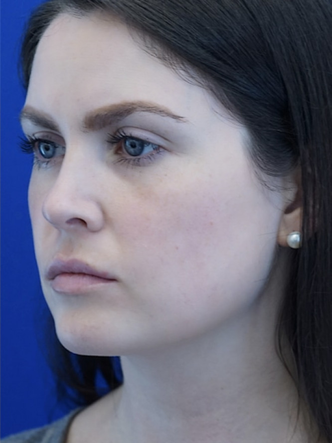 Nasal Tip and Narrow Cheek — After