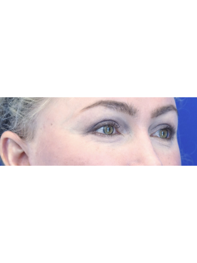 Elegant Eyelid Appearance — After