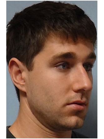 Crooked Nose & Dorsal Hump2* — Before