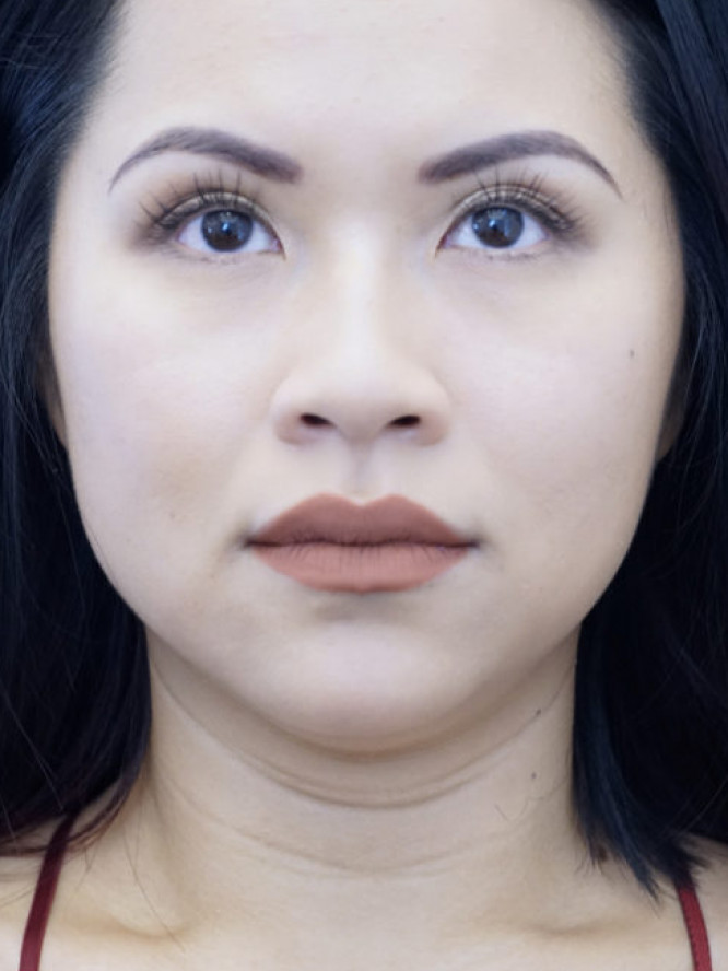 Submental LipoSculpture — Before