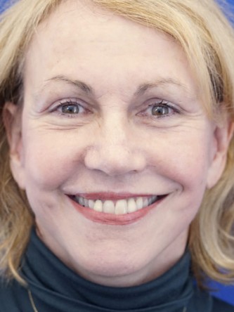 Deep Plane Lift and Superficial Laser — After