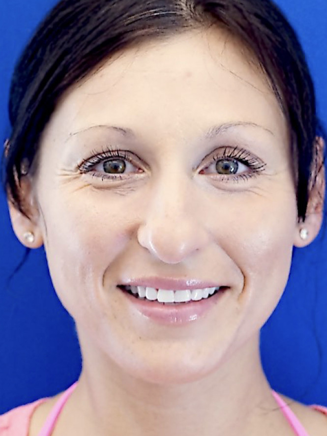 Downturn Tip Endonasal Rhinoplasty — Before