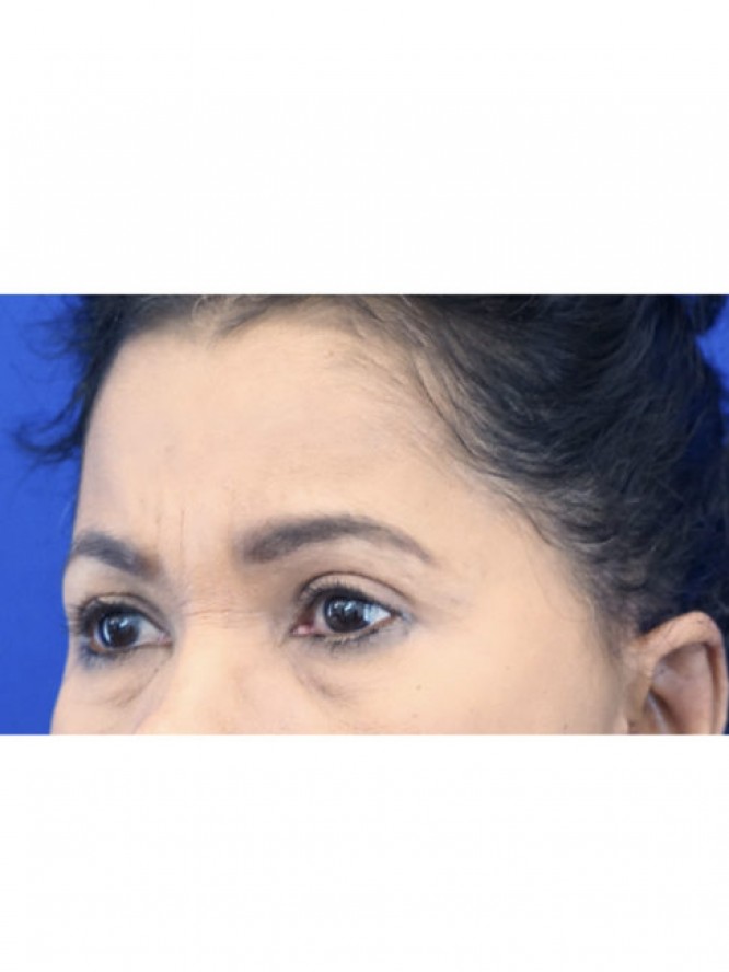 Endoscopic Forehead Lift — After