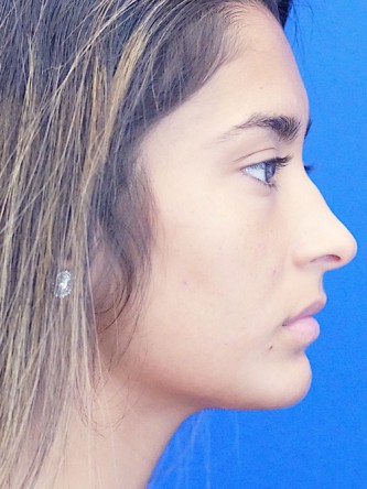 Voluptuous Lip Enhancement* — Before