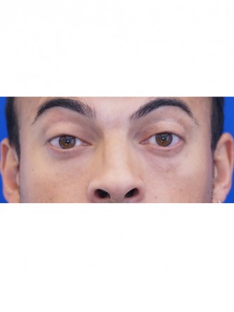 Fat Transfer to Lower Eyelid* — Before