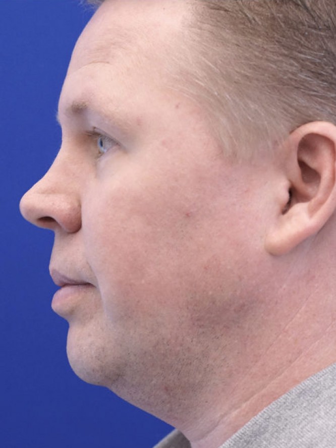 Mild Nasal Deviation — After