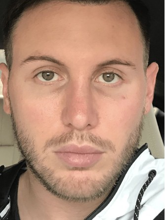Nasal Upper Third Bony Asymmetry* — After