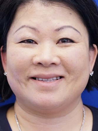 Asian Blepharoplasty — Before