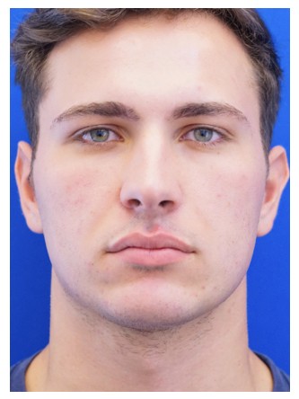 Buccal Fat Excision — Before