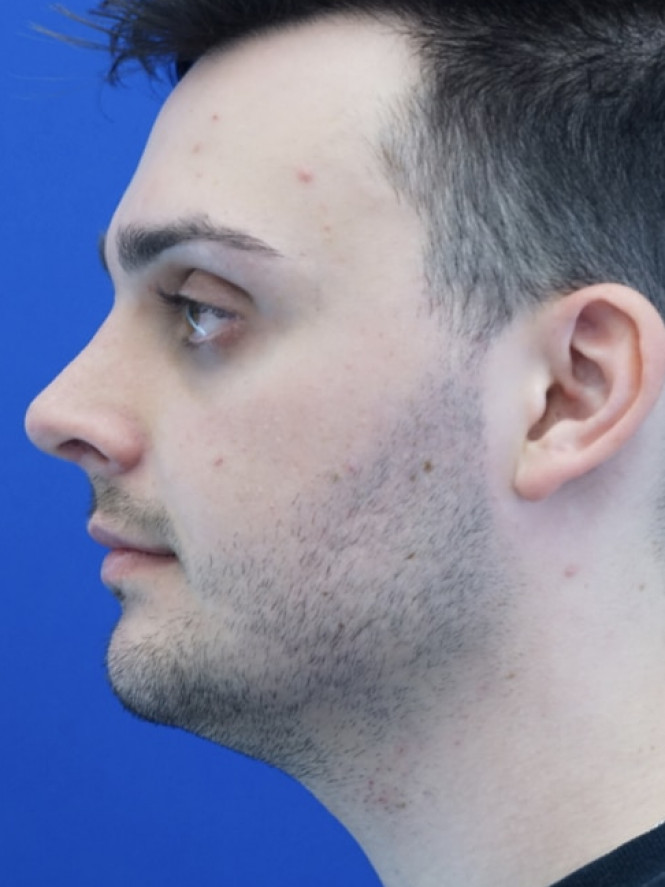 Profile Enhancement — After