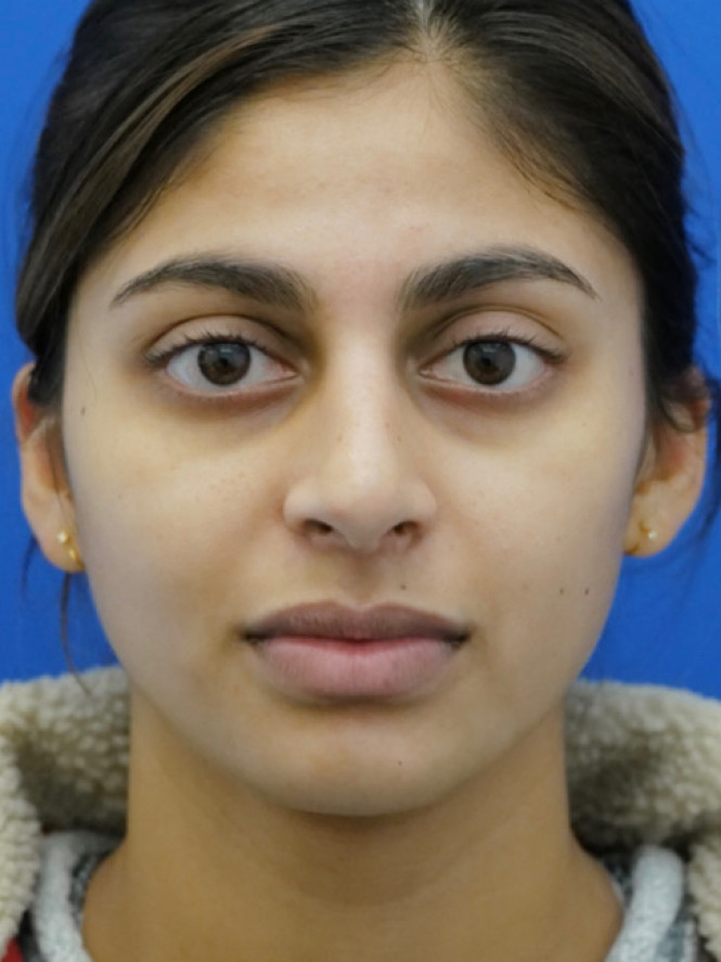 Natural Result — After