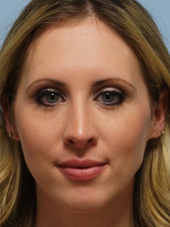 Crooked Nose & Cartilage Deformity1* — After
