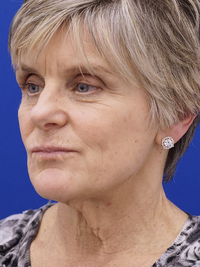 Lower Facelift Deep Plane — Before